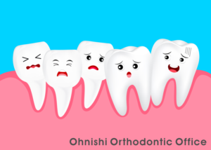 歯並びの叢生